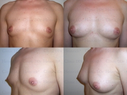 dBreast augmentation with stem cell-enriched autologous fat