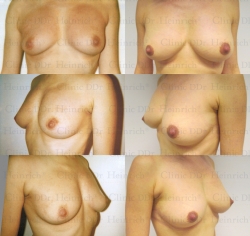 Breast augmentation with stem cell-enriched autologous fat