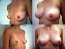 Breast augmentation with stem cell-enriched autologous fat